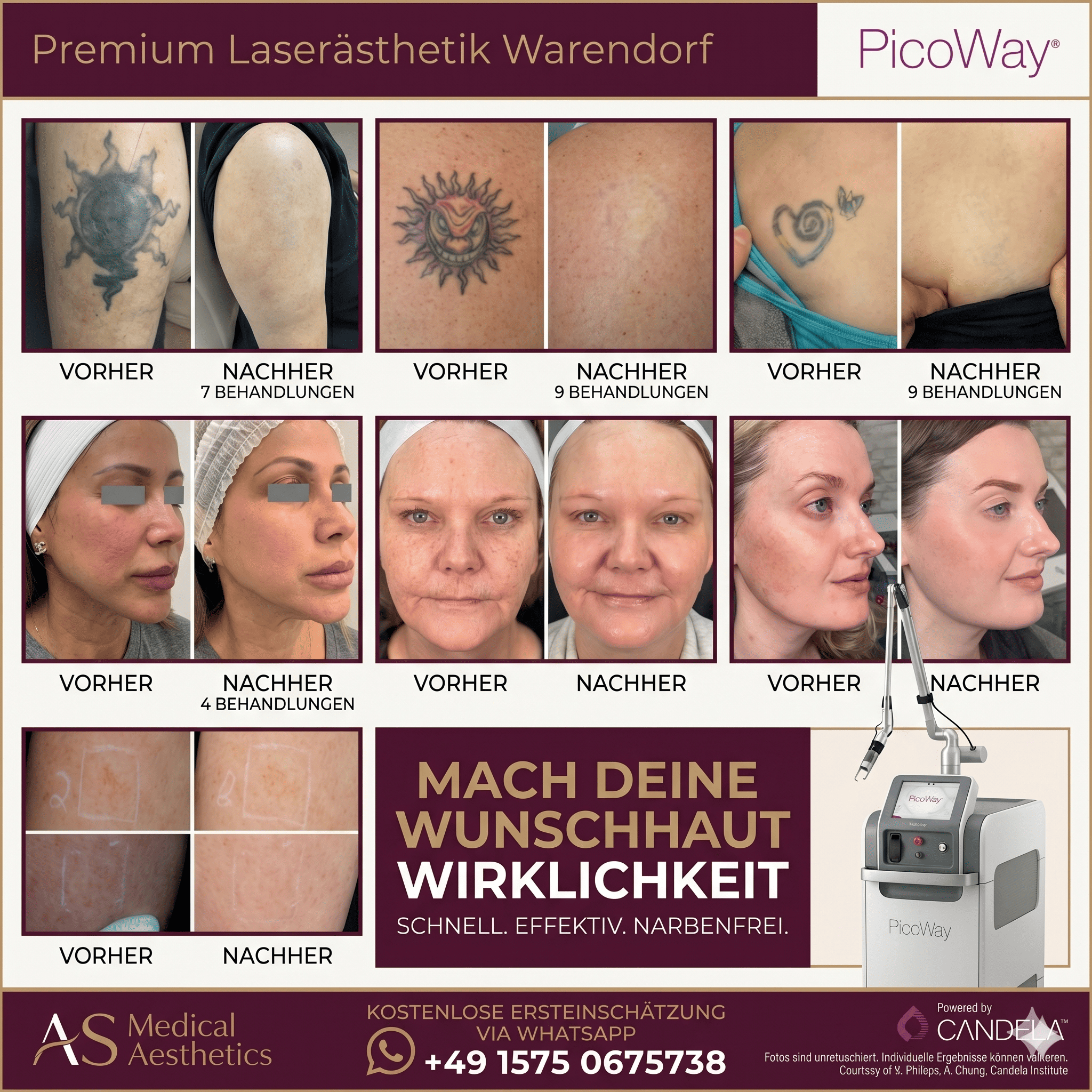 PicoWay Laser Hautverjüngung Pigmentflecken und Tattooentfernung in Warendorf