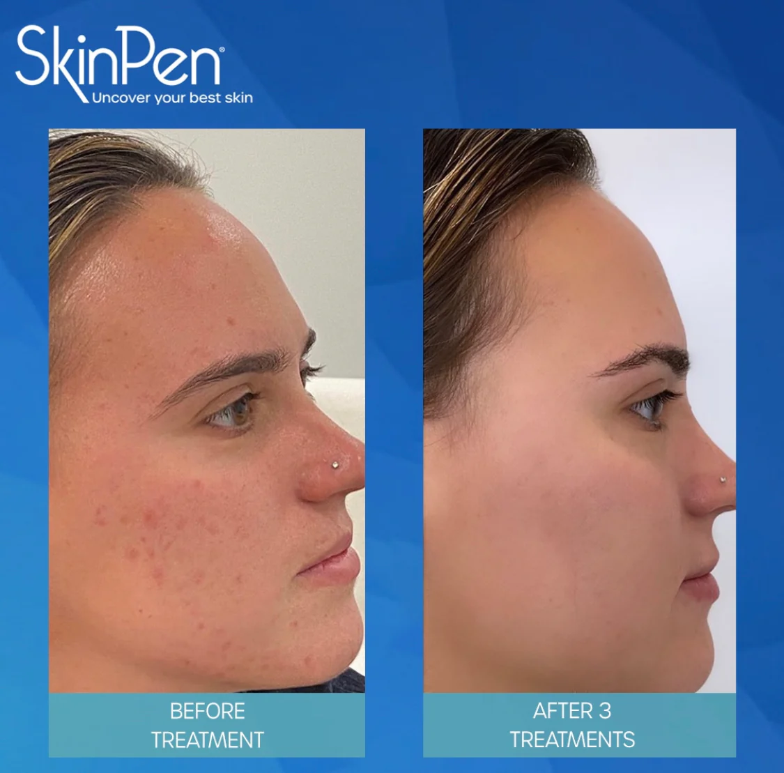 Aknenarben Behandlung Warendorf SkinPen Microneedling