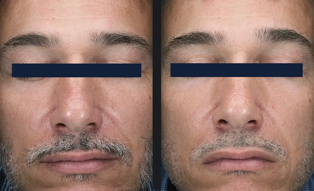 Glacé Hydrodermabrasion Tiefenreinigung Vorher-Nachher Ergebnis