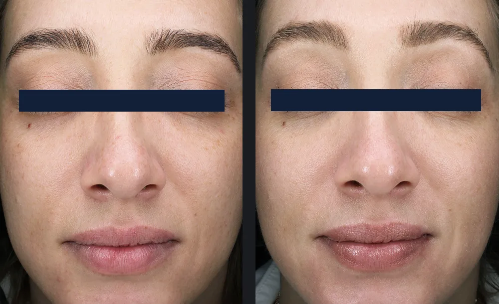 Glacé Hydrodermabrasion Tiefenreinigung Vorher-Nachher Ergebnis