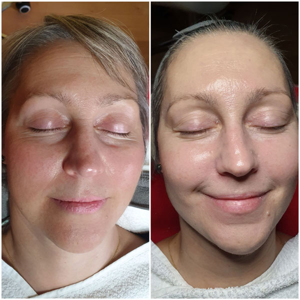 PRP Eigenbluttherapie