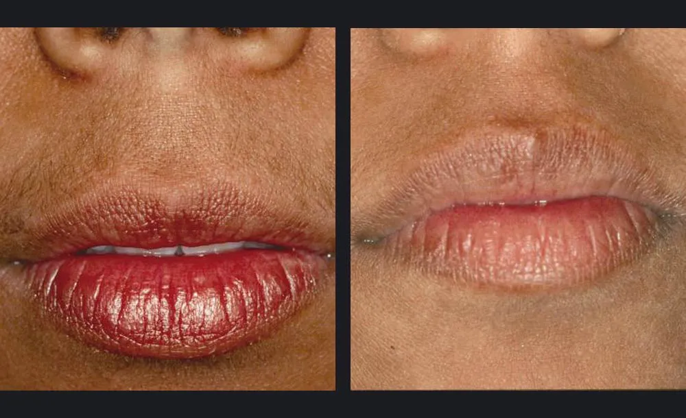 Candela Nordlys Lasertherapie klinisches Vorher-Nachher Ergebnis