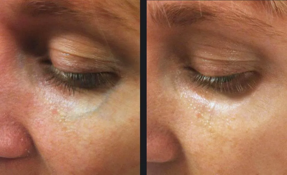 Candela Nordlys Lasertherapie klinisches Vorher-Nachher Ergebnis