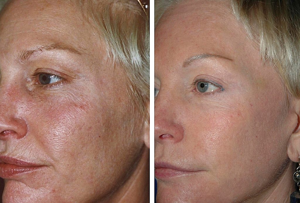 Fraktionierte Lasertherapie Aknenarben Warendorf