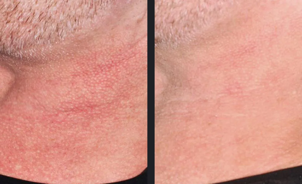 Laserbehandlung Gefäße Rötungen Rosacea Warendorf