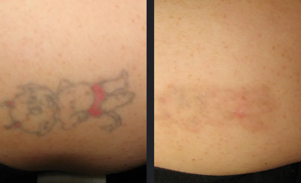 Tiefenmessung - Laser Tattooentfernung in Warendorf | Praxis AS Aesthetics Warendorf