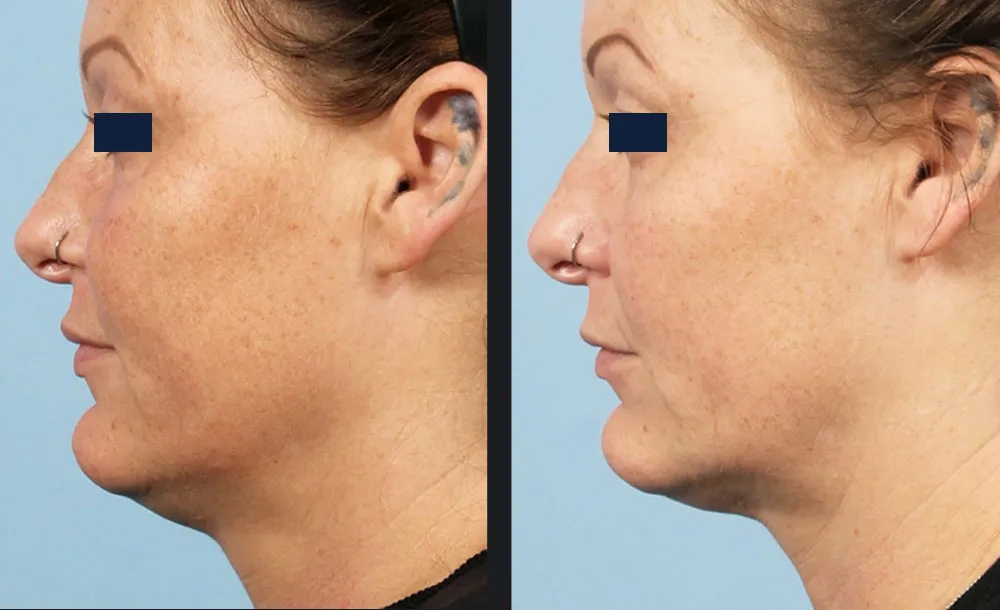 Matrix Pro RF-Microneedling Vorher-Nachher-Vergleich an Kieferlinie und Hals