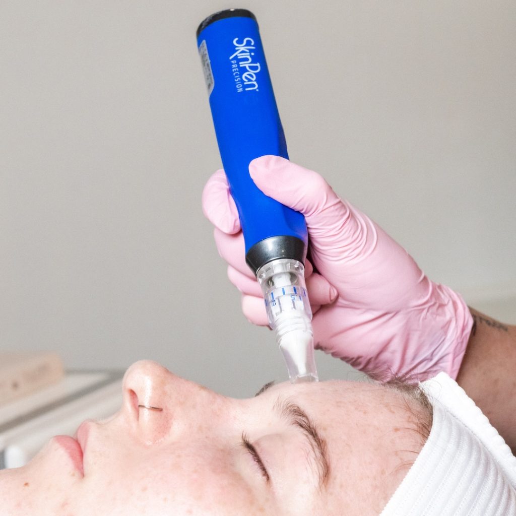 SkinPen Precision Behandlung