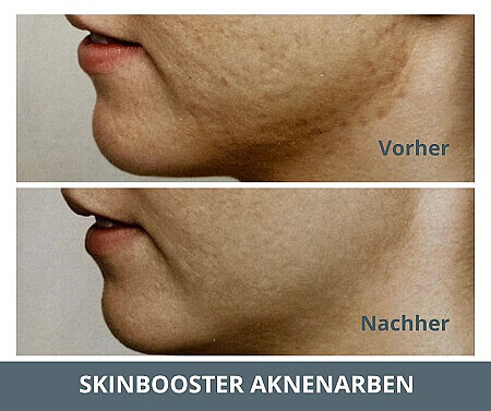 Skinbooster Hyaluronsäure Tiefenfeuchtigkeit Vorher-Nachher Ergebnis