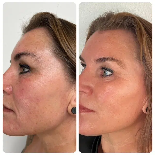 Skinbooster Hyaluronsäure Tiefenfeuchtigkeit Vorher-Nachher Ergebnis