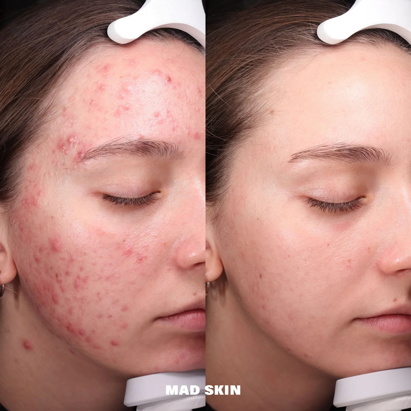 Klinisches Vorher-Nachher Ergebnis der Aknenarben-Behandlung mit SkinPen