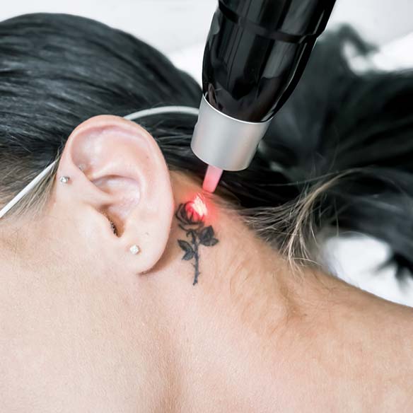 PicoWay® vs. herkömmliche Nanolaser: Der Unterschied bei der Tattooentfernung