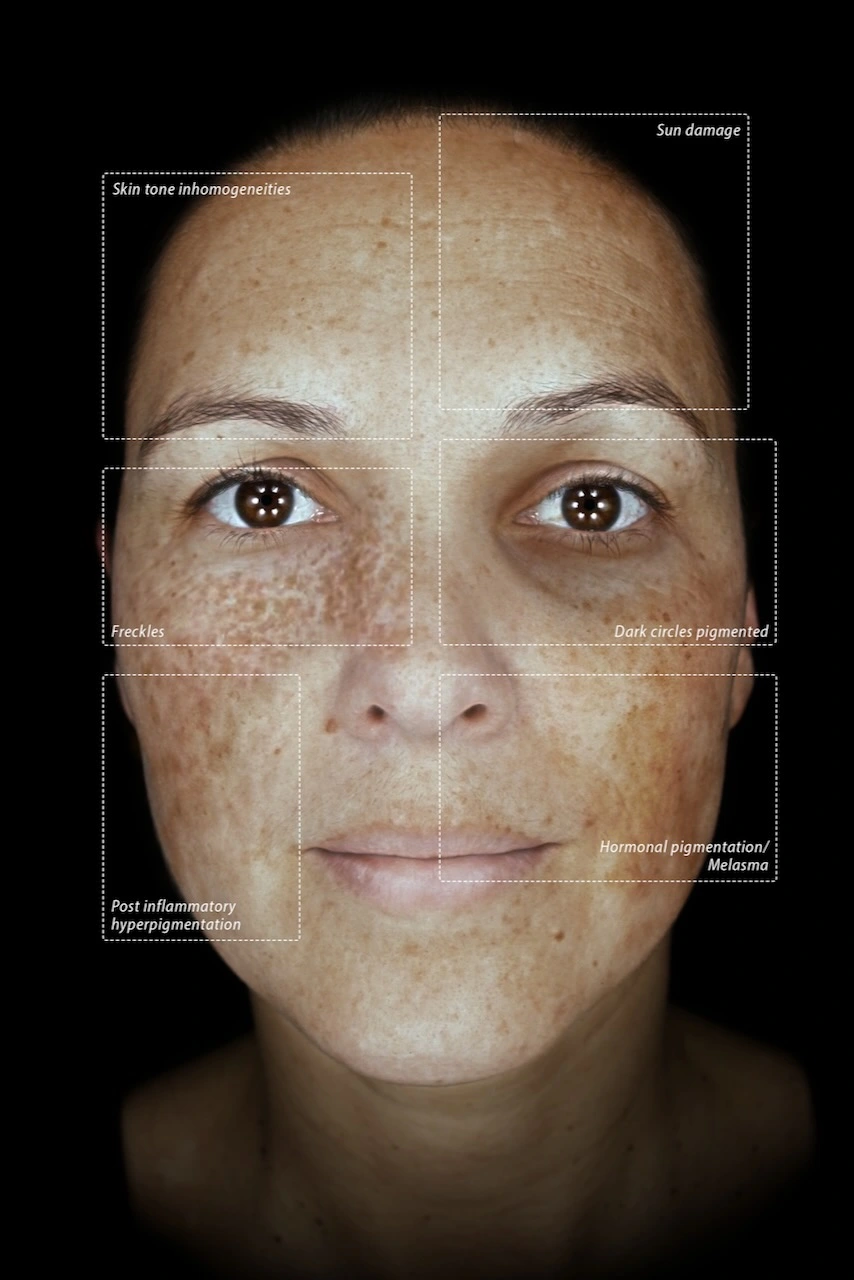 Pigmentation Mode OBSERV 520x Skin Diagnostics Bielefeld Gütersloh