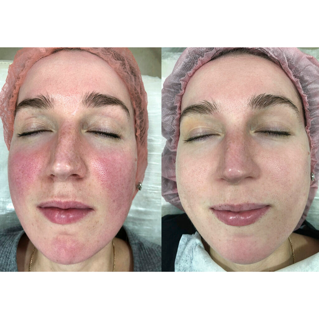 Rosacea Behandlung