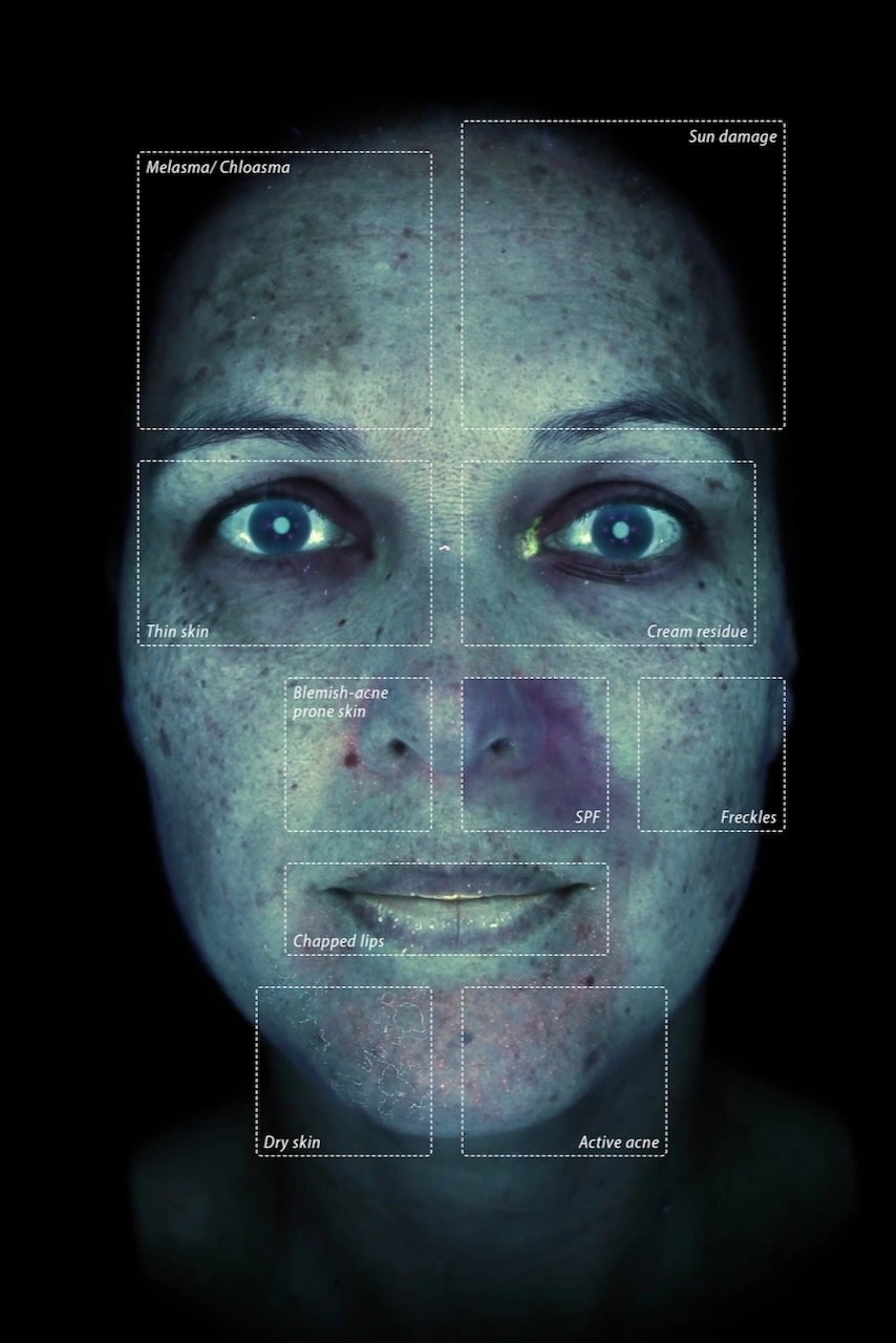 True UV Mode OBSERV 520x Skin Diagnostics Münster