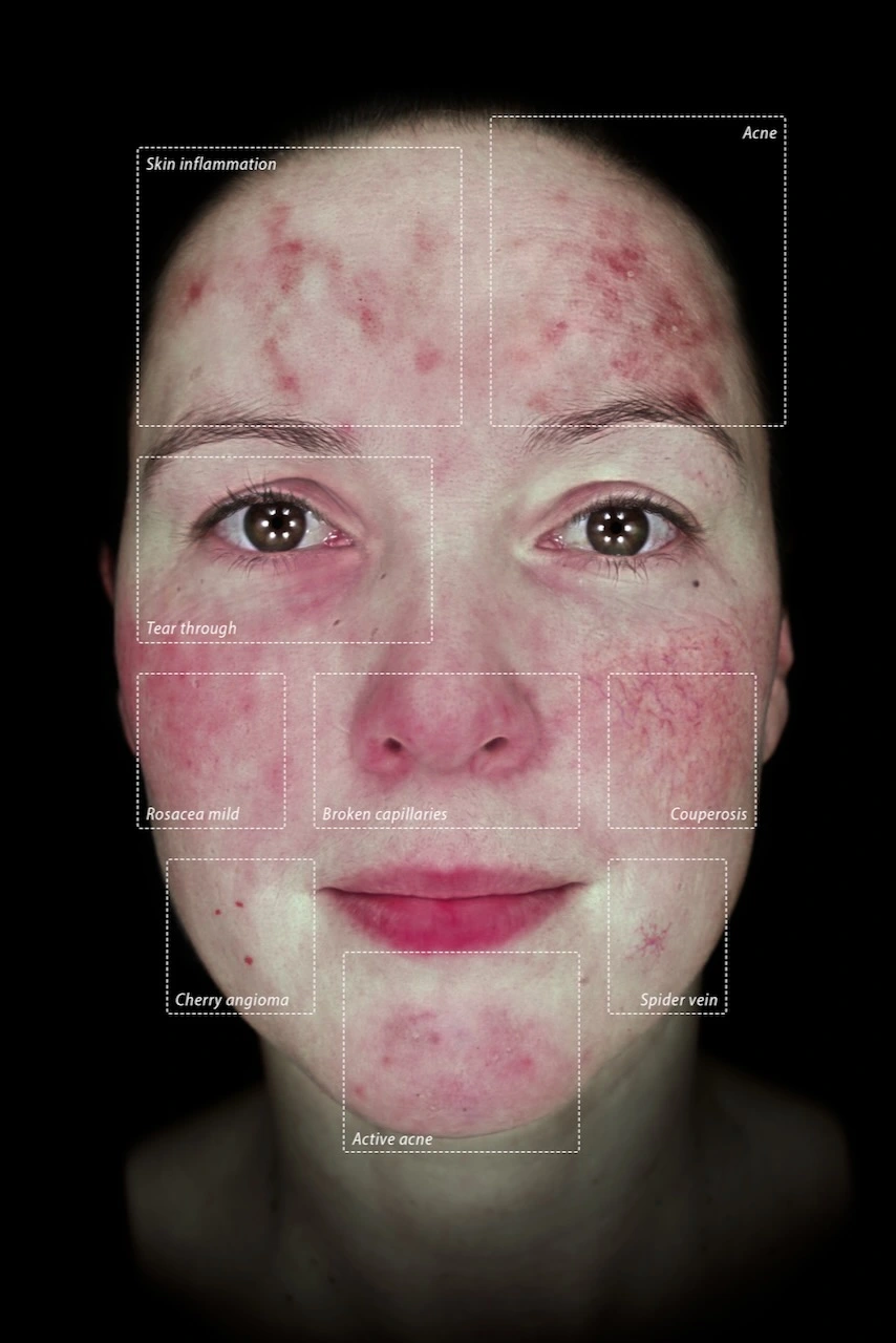Vascularity Mode skin analysis Osnabrück Paderborn