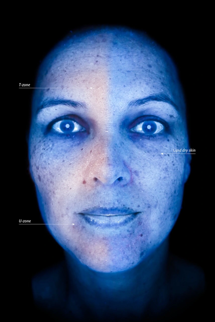 Woods Light OBSERV 520x skin analysis Osnabrück