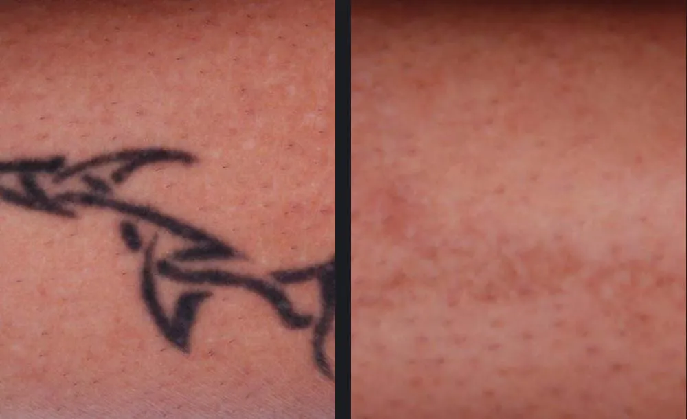 Before - Skin analysis Warendorf & Münster | OBSERV 520x