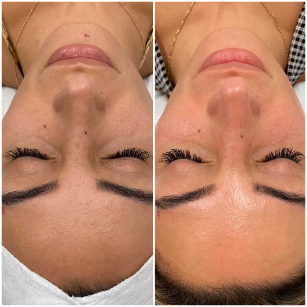 SkinPen Mikro İğneleme Kırışıklıkları ve Cilt Yenileme Münster