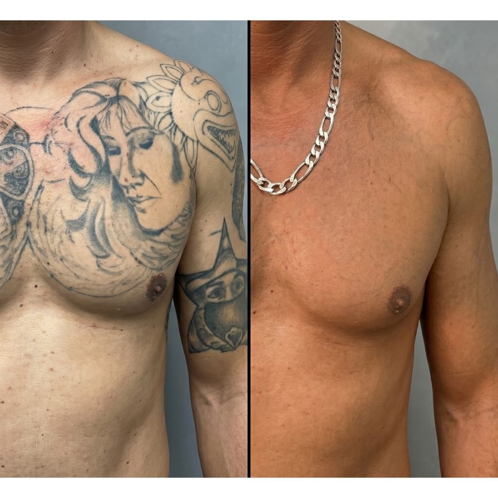 Tattooentfernung